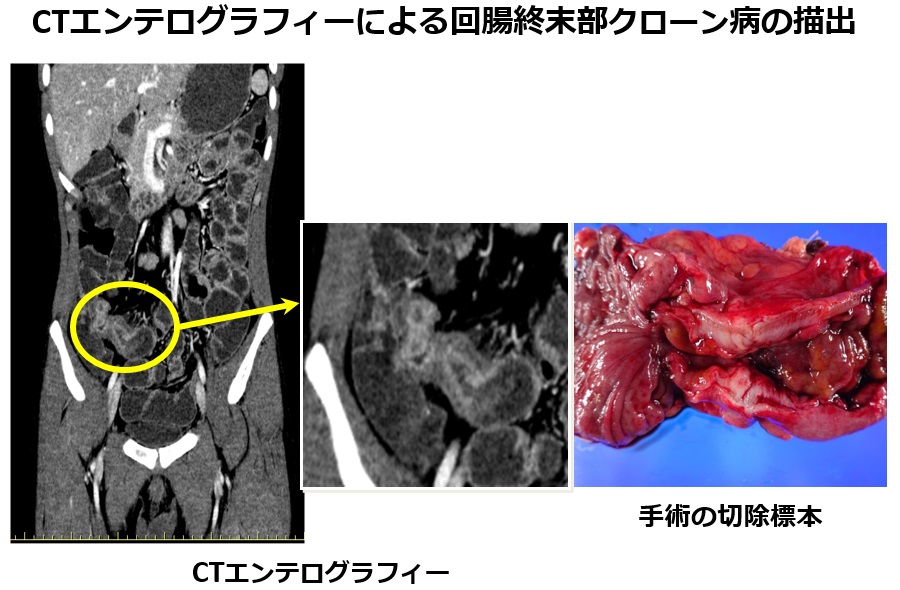 CTエンテログラフィーによる回腸終末部クローン病の描出